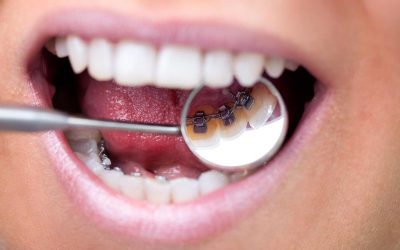 Intérêts d’un traitement orthodontique