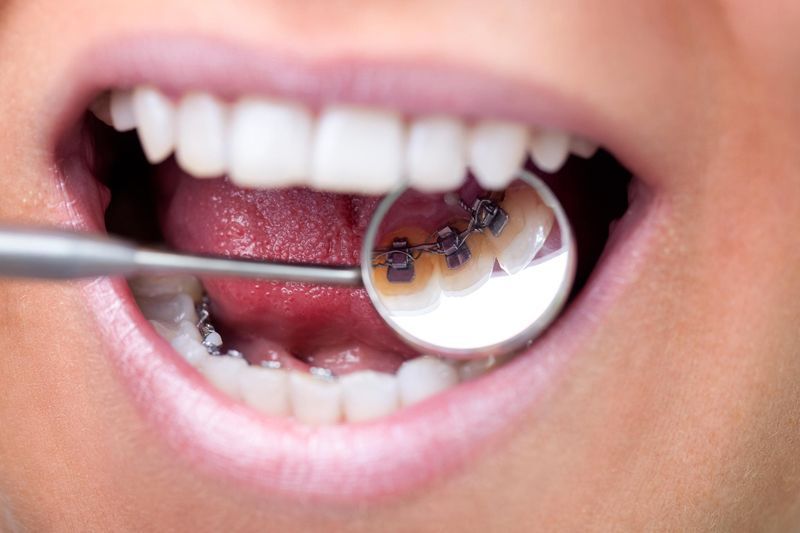 Orthodontie-linguale Le Dr Séverin réalise des soins en orthodontie