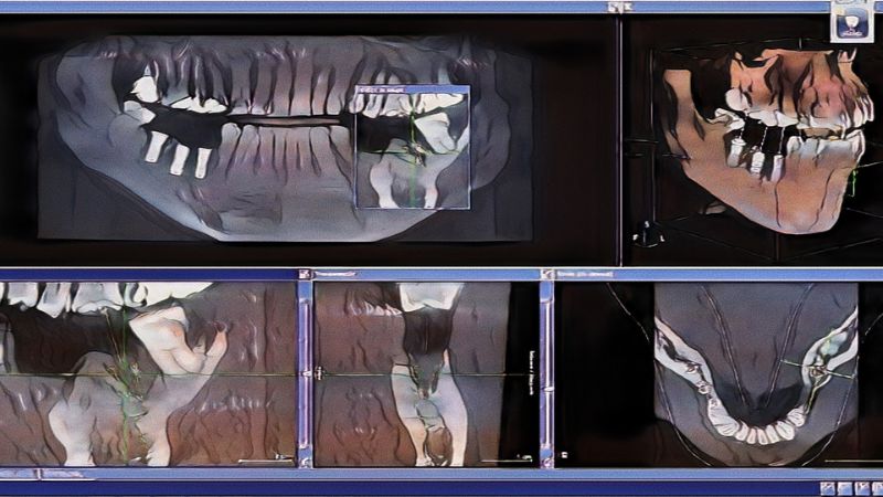 Les résultats d'un scanner dentaire 3D