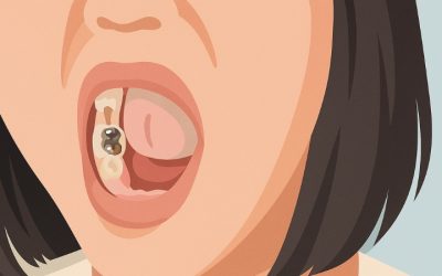Couronne dentaire à Paris : types, conseils et prix