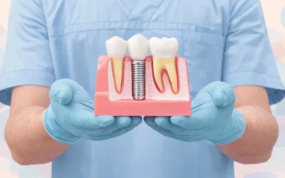Combien de séances pour un implant dentaire ?